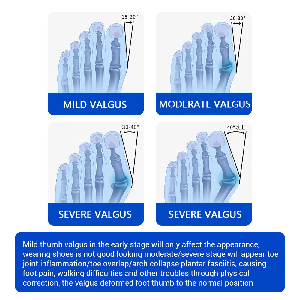 Adjustable Toe Corrector for Painless Bunion Alignment - 5