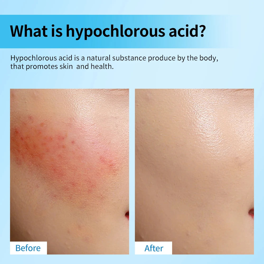 Hypochlorous Acid Facial Spray for Skin Recovery - 3